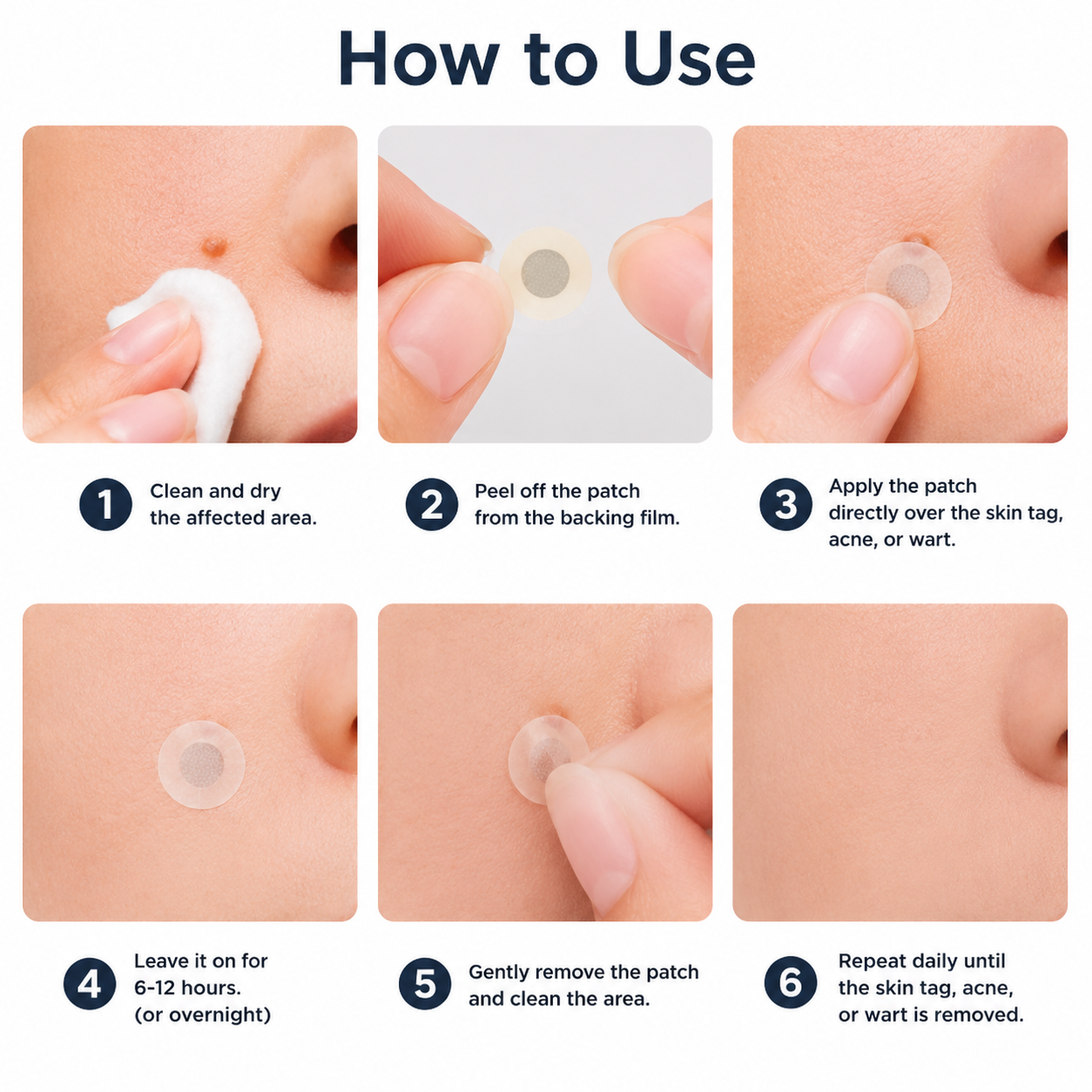 ✨Alcuras® 2-in-1 Microneedle & Hydrocolloid Patch🍀| Removes Raised Moles, Acne, Flat Warts & Skin Tags | Helps Improve Wrinkles, Scars & Blemishes | Invisible Patches for Face & Body