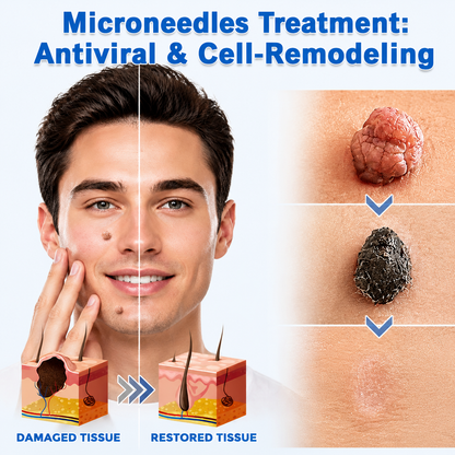 ✨Alcuras® 2-in-1 Microneedle & Hydrocolloid Patch🍀| Removes Raised Moles, Acne, Flat Warts & Skin Tags | Helps Improve Wrinkles, Scars & Blemishes | Invisible Patches for Face & Body
