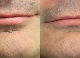 ✨Alcuras® 2-in-1 Microneedle & Hydrocolloid Patch🍀| Removes Raised Moles, Acne, Flat Warts & Skin Tags | Helps Improve Wrinkles, Scars & Blemishes | Invisible Patches for Face & Body