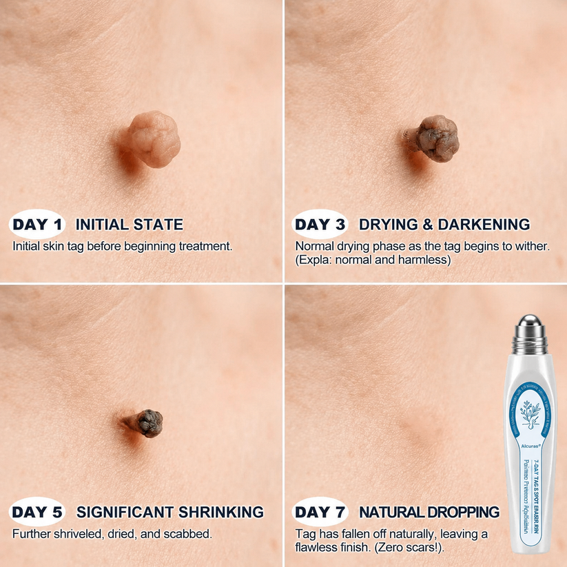 Alcuras® 7-𝐷𝑎𝑦 𝗧𝐚𝐠 & 𝗦𝗽𝐨𝐭 𝐄𝐫𝒂𝒔𝒆𝒓(Zero Pain, Zero 𝐒𝐜𝐚𝒓𝒔 Rollerball)