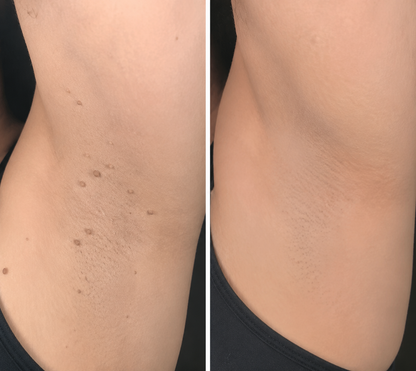 ✨Alcuras® 2-in-1 Microneedle & Hydrocolloid Patch🍀| Removes Raised Moles, Acne, Flat Warts & Skin Tags | Helps Improve Wrinkles, Scars & Blemishes | Invisible Patches for Face & Body