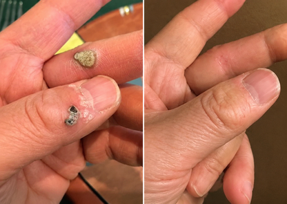 ✨Alcuras® 2-in-1 Microneedle & Hydrocolloid Patch🍀| Removes Raised Moles, Acne, Flat Warts & Skin Tags | Helps Improve Wrinkles, Scars & Blemishes | Invisible Patches for Face & Body